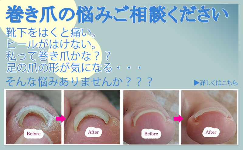 巻き爪ケア、青森市巻き爪矯正、巻き爪治療